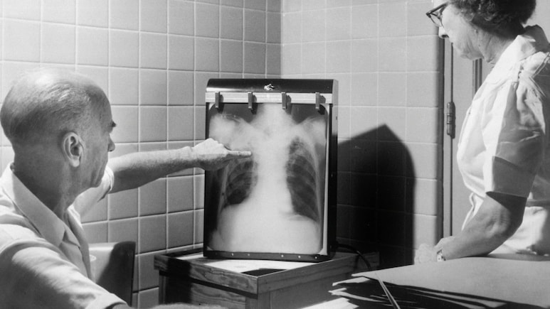 Tuberculosis Bacteria Are Mutating, Turning Antibiotic Resistant: IIT Bombay Study