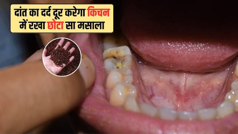 किचन में रखे इस छोटे से मसाले से करें दांत का दर्द ठीक, डॉक्टर ने बताया इस्तेमाल करने का सही तरीका