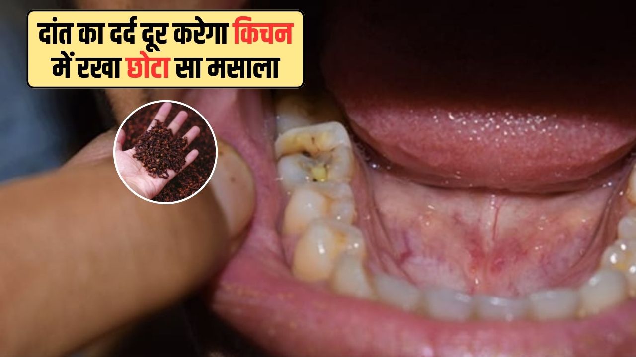 दांत में दर्द हो तो क्या करें, Dant me dard ho to kya kare, Dant dard ka turant ilaj, Home remedies for toothache, दांत दर्द के घरेलू उपाय, danton me keeda lagna, tooth pain relief instantly, dant dard ka gharelu nuskha, how to stop toothache fast Latest and Breaking News on NDTV