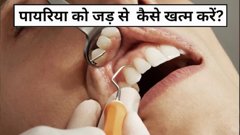 किचन में मौजूद ये चीजें दांतों में लगे पायरिया को जड़ से कर देंगी खत्म, जान लें इस्तेमाल का तरीका