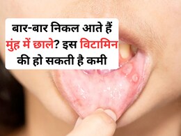 मुंह के छाले किस विटामिन की कमी से होते हैं? ये 3 आसान घरेलू नुस्खे तुरंत दिलाएंगे आराम