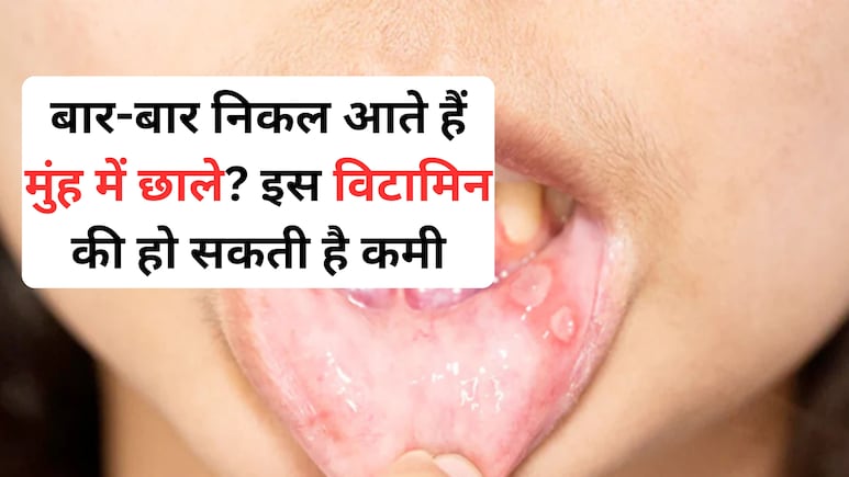 मुंह के छाले किस विटामिन की कमी से होते हैं? ये 3 आसान घरेलू नुस्खे तुरंत दिलाएंगे आराम