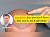 हेयर ट्रांसप्लांट के कितने दिन बाद बाल धो सकते हैं? नहीं रखी ये सावधानियां तो ट्रांसप्लांट हो सकता है फेल