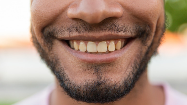Not Coffee Or Smoking, These 10 Surprising Daily Habits Are Staining Your Teeth