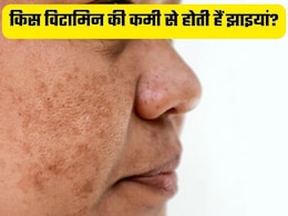 शरीर में किन विटामिन्स की कमी से चेहरे पर होती है झाइयां, क्या खाने से होगा इनका परमानेंट इलाज