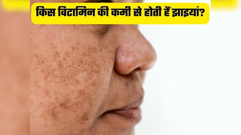 शरीर में किन विटामिन्स की कमी से चेहरे पर होती है झाइयां, क्या खाने से होगा इनका परमानेंट इलाज