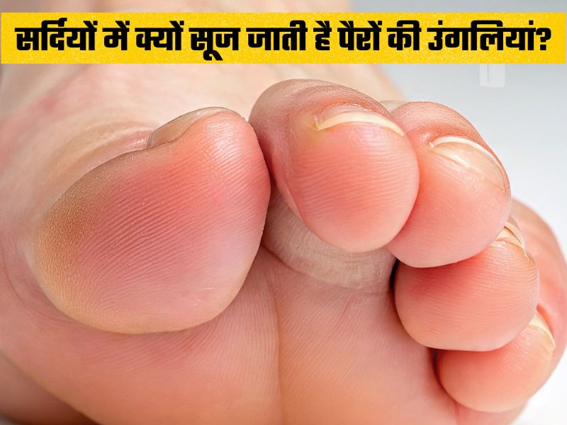 किस विटामिन की कमी से सर्दियों में सूज जाती हैं पैर की उंगलियां, क्या खाकर दूर होगी समस्या