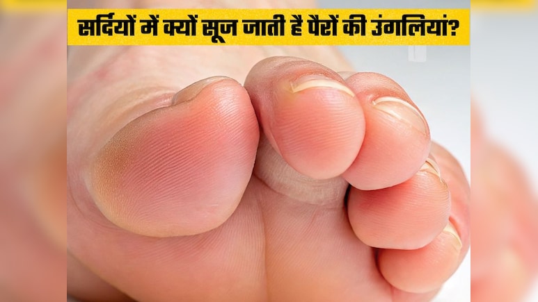 किस विटामिन की कमी से सर्दियों में सूज जाती हैं पैर की उंगलियां, क्या खाकर दूर होगी समस्या