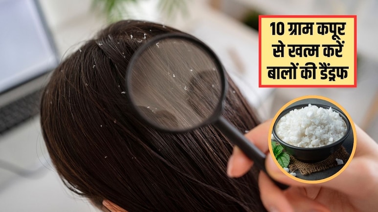 10 ग्राम कपूर से दूर हो जाएगी बालों की रूसी, डॉक्टर सुभाष गोयल ने बताया इस्तेमाल करने का सही तरीका