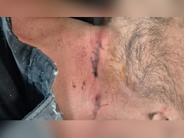 ब्रेक ने बचाई जान: परीक्षा देकर लौट रहे छात्र का चाइनीज मांझे से कटा गला, 10 टांके लगे, बाल-बाल बचा