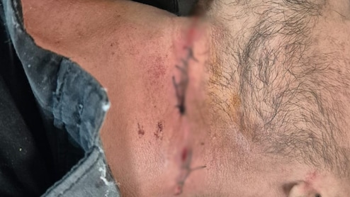 ब्रेक ने बचाई जान: परीक्षा देकर लौट रहे छात्र का चाइनीज मांझे से कटा गला, 10 टांके लगे, बाल-बाल बचा