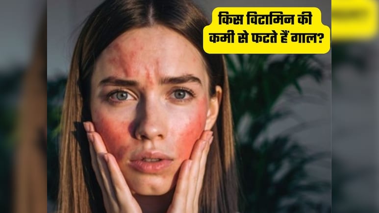 शरीर में किस विटामिन की कमी से सर्दियों में फटते हैं गाल, क्या खाने से होंगे ठीक