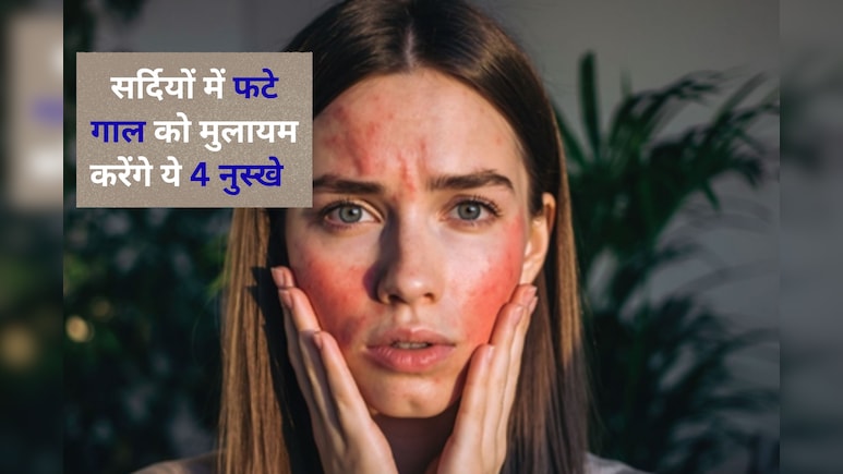 सर्दियों में फट गए हैं गाल? अपनाएं ये 4 नुस्खे, फिर से चिक्स हो जाएंगे मुलायम और चमकदार