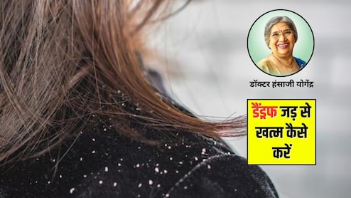 रूसी को जड़ से कैसे खत्म करें? डॉक्टर हंसाजी ने बताए 5 घरेलू नुस्खे, डैंड्रफ से तुरंत मिलेगा छुटकारा
