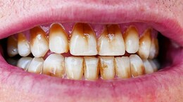 Can Bad Oral Health Cause Diabetes And Kidney Disease? Science Says Yes, Here's How