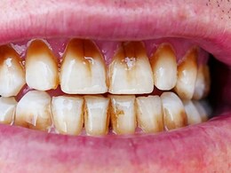 Can Bad Oral Health Cause Diabetes And Kidney Disease? Science Says Yes, Here's How