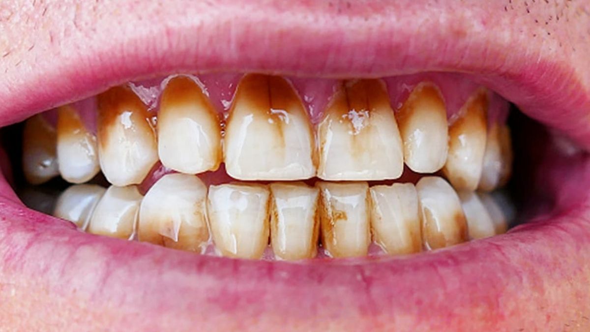 Bad Oral Health Cause Diabetes And Kidney Disease