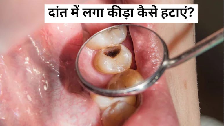 दांत में लगा कीड़ा या खोखला हो गया है दांत, तो अपनाएं Dr. Saleem Zaidi के बताएं ये नुस्खे, फिर से नए जैसा होगा दांत