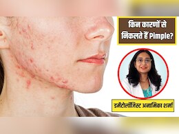 स्किन की डॉक्टर ने बताया किन कारणों से निकलते हैं Pimples, ये 5 लक्षण पहले ही जान लेगें तो कभी नहीं होंगे मुंहासे