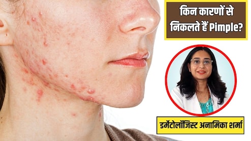 स्किन की डॉक्टर ने बताया किन कारणों से निकलते हैं Pimples, ये 5 लक्षण पहले ही जान लेगें तो कभी नहीं होंगे मुंहासे