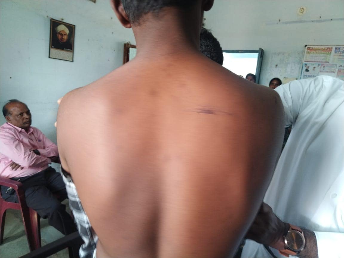 Telangana Student Brutally Assaulted: 20 Seniors Attack Class 10 Vice-Captain in School Hostel