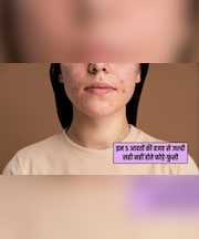 इन 5 आदतों की वजह से जल्दी ठीक नहीं होते चेहरे के फोड़े और फुंसियां, डर्मेटोलॉजिस्ट ने बताई असली वजह