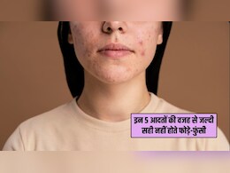 Acne Treatment Tips: इन 5 आदतों की वजह से जल्दी ठीक नहीं होते चेहरे के फोड़े और फुंसियां, डर्मेटोलॉजिस्ट ने बताई असली वजह