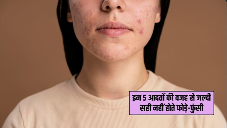 Acne Treatment Tips: इन 5 आदतों की वजह से जल्दी ठीक नहीं होते चेहरे के फोड़े और फुंसियां, डर्मेटोलॉजिस्ट ने बताई असली वजह