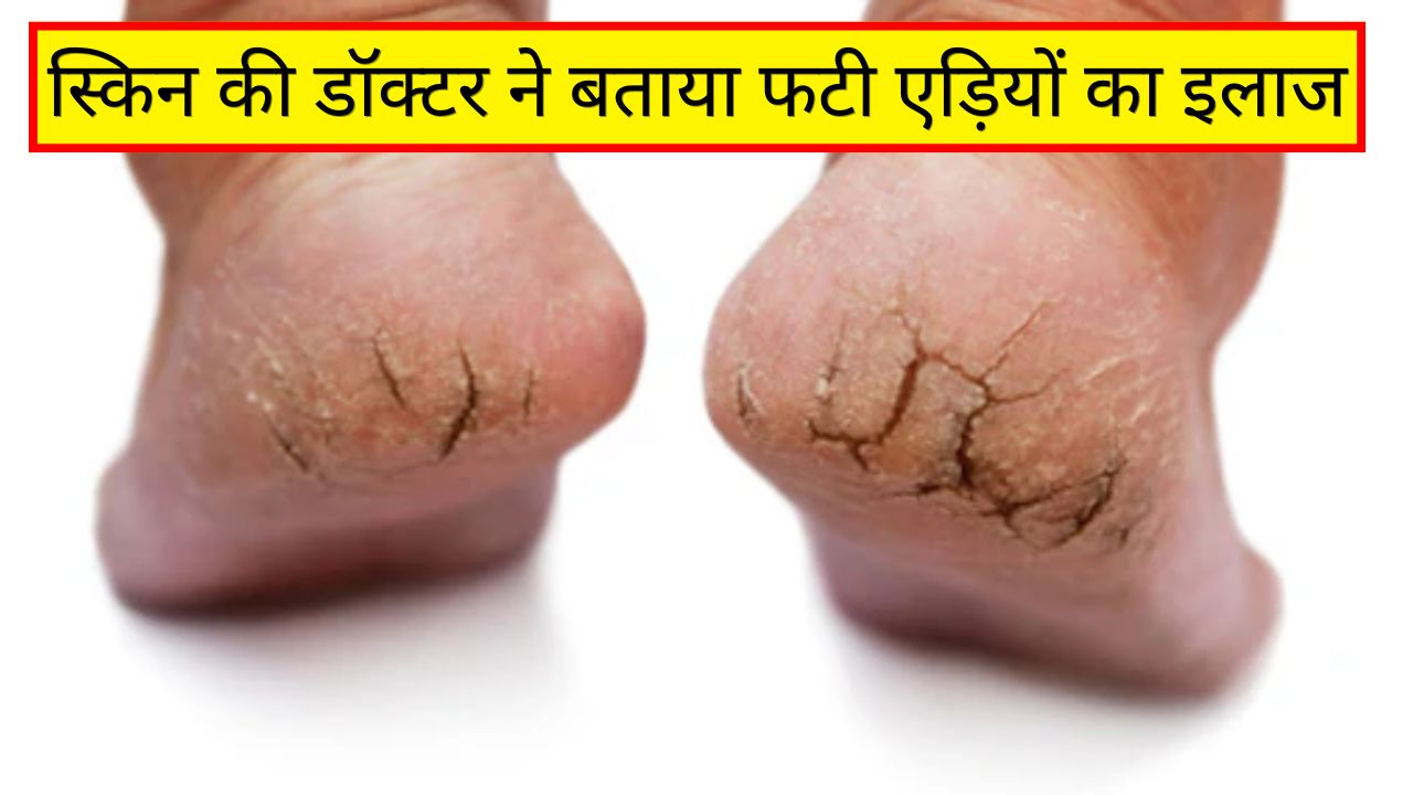 फटी एड़ियों का सही इलाज क्या है? स्किन की डॉक्टर ने बताया एड़ी फट जाएं तो सबसे पहले क्या करें
