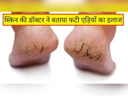 फटी एड़ियों का सही इलाज क्या है? स्किन की डॉक्टर ने बताया एड़ी फट जाएं तो सबसे पहले क्या करें