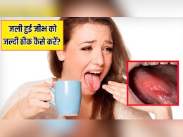गरम खाने से तालु जल जाए तो क्या करें? जानें जली हुई जीभ को जल्दी ठीक कैसे करें
