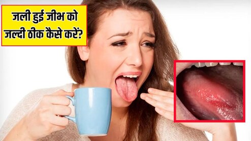 गरम खाने से तालु जल जाए तो क्या करें? जानें जली हुई जीभ को जल्दी ठीक कैसे करें