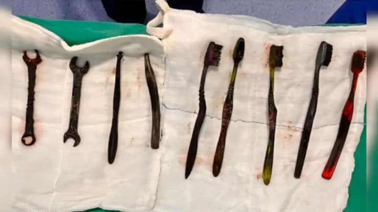 Shocking! पोटदुखीने त्रस्त तरुण डॉक्टरकडे गेला, पोटात दिसलं असं साहित्य, तब्बल 9 ब्रश अन्...