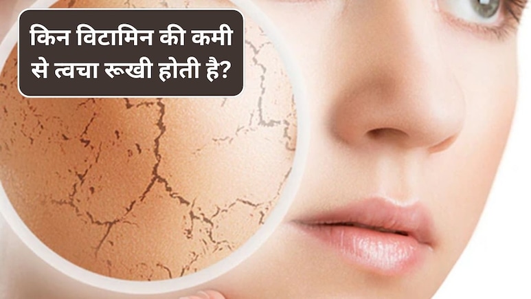 सर्दी में किन विटामिन की कमी से त्वचा रूखी होती है? न्यूट्रिशनिस्ट ने बताया इन चीजों को खाने से स्किन होगी नेचुरली ठीक