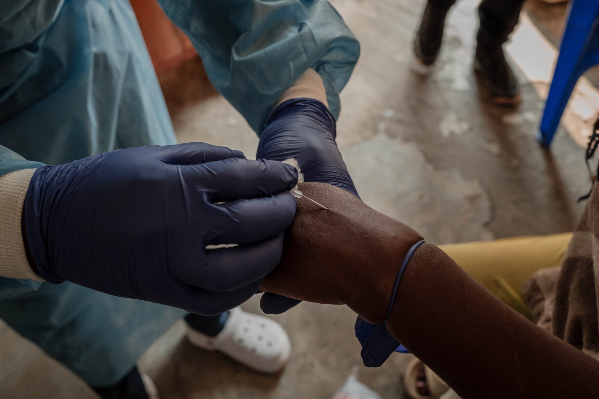 Mpox Risks Heighten With Mosaic Of Infection Patterns