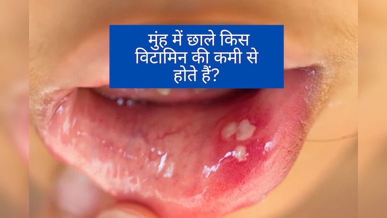 किस Vitamin की कमी से मुंह में निकलते हैं बार-बार छाले? | Muh me chale kyun nikalte hain