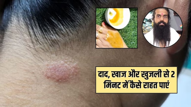 दाद, खाज और खुजली से कैसे छुटकारा पाएं? योग गुरु कैलाश ने बताया हल्दी के साथ लगा लें ये चीज, 2 मिनट में मिल जाएगा आराम