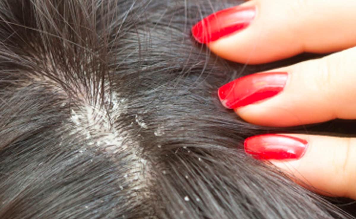 4 Natural Remedies For Winter Hair Fall And Dandruff