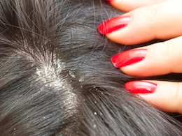 4 Natural Remedies For Winter Hair Fall And Dandruff
