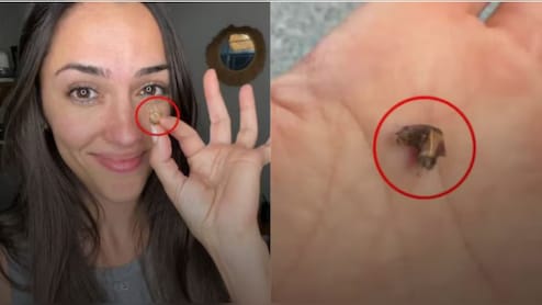 35 सालों से महिला की नाक में फंसी थी ये चीज, जब डॉक्टर ने निकाला तो हर कोई दंग रह गया