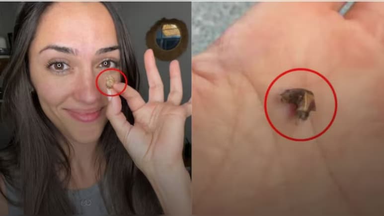 35 सालों से महिला की नाक में फंसी थी ये चीज, जब डॉक्टर ने निकाला तो हर कोई दंग रह गया