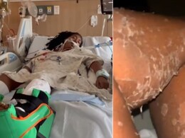 मकड़ी के काटने से सांप की तरह उतरने लगी त्वचा, महिला ने बताया- ऐसा कैसे हो गया?