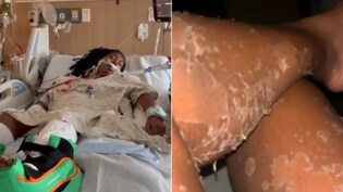 मकड़ी के काटने से सांप की तरह उतरने लगी त्वचा, महिला ने बताया- ऐसा कैसे हो गया?