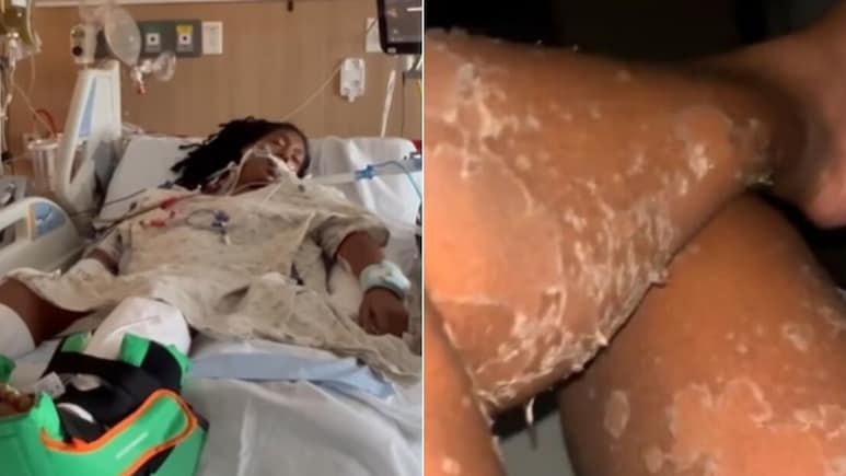 मकड़ी के काटने से सांप की तरह उतरने लगी त्वचा, महिला ने बताया- ऐसा कैसे हो गया?