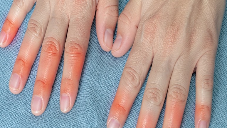 सर्दियों में क्यों हाथ और पैरों की उंगलियों में हो जाती है सूजन? जानें कैसे मिलेगी राहत