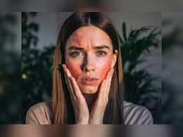 सर्दियों में फटे गाल और रुखी त्वचा देते हैं ये संकेत, राहत के लिए अपनाने होंगे ये उपाय