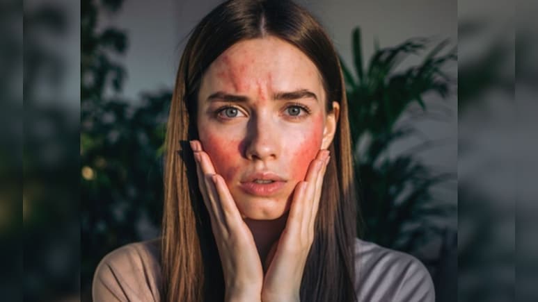 सर्दियों में फटे गाल और रुखी त्वचा देते हैं ये संकेत, राहत के लिए अपनाने होंगे ये उपाय