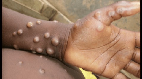 Two Cases Of MPox Reported In Kerala, Health Minister Confirms