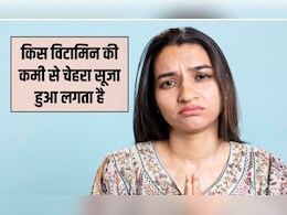 कौन सा विटामिन खाने से गाल फूलता है? किस कमी की वजह से चेहरा सूज जाता है, जान‍िए यहां