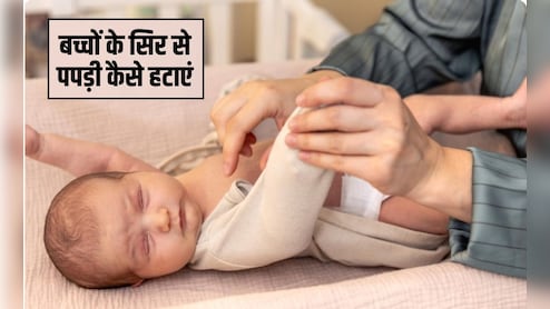 बच्चों के सिर से पपड़ी कैसे हटाएं? मेरे बच्चे की खोपड़ी क्यों छील रही है, हर सवाल का जवाब डॉक्&zwj;टर से जान&zwj;िए